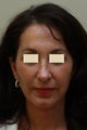 Face & Neck Lift, Browlift, Chin Enhancement