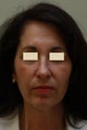 Face & Neck Lift, Browlift, Chin Enhancement