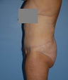 Body Lift