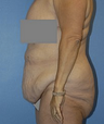 Body Lift