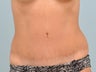 Tummy tuck disaster is saved by secondary pull