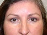 Forehead Lift, Brow Lift and Upper Eyelid Surgery