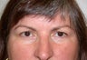 Forehead Lift, Brow Lift and Upper Eyelid Surgery