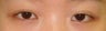 Revision Bilateral Asian Eyelid Surgery
