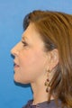 K-Lift ® the Non Surgical Neck Lift