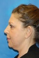 K-Lift ® the Non Surgical Neck Lift