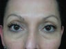 Blepharoplasty, Female