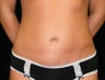 Mini Tummy Tuck
