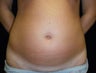 Mini Tummy Tuck