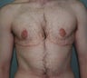 38-Year-Old Male Breast Reduction