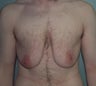 38-Year-Old Male Breast Reduction