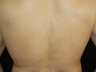 Laser Hair Removal