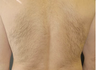 Laser Hair Removal