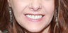 30 year old female treated with All-on-4 Dental Implant Procedure
