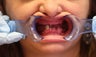 30 year old female treated with All-on-4 Dental Implant Procedure