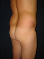 Butt Augmentation
