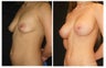 Breast Implants