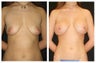 Breast Implants