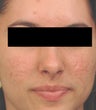 Acne Laser Treatment