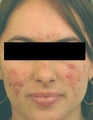Acne Laser Treatment