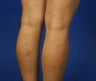 36 Year Old Female Treated for Varicose Veins