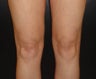 SmartLipo MPX