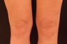 SmartLipo MPX