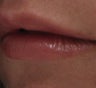 Lip Enhancement with Juvederm Ultra