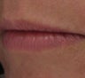 Lip Enhancement with Juvederm Ultra