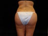 Brazilian Buttocks Lift