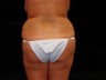 Brazilian Buttocks Lift