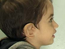 Total Ear Reconstruction Surgery for Microtia