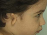 Total Ear Reconstruction Surgery for Microtia