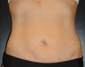 SmartLipo MPX