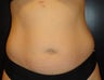 SmartLipo MPX
