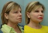 Facial Reconstructive Surgery