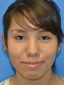 14 year old Female with Prominent Ears Treated with Otoplasty/Ear Surgery