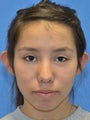 14 year old Female with Prominent Ears Treated with Otoplasty/Ear Surgery