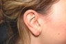 Gauged earlobe repair