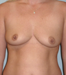 Breast Implants