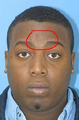 Facial Reconstruction