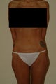 lax thigh and buttocks