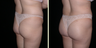 Brazilian Butt Lift