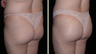 Brazilian Butt Lift