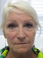 Wrinkle treatment for woman for lower face
