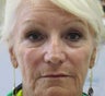 Wrinkle treatment for woman for lower face