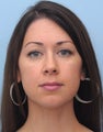 Non-Surgical Chin Augmentation Using Perlane