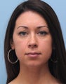 Non-Surgical Chin Augmentation Using Perlane