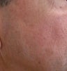 58 year old Male with undesired Pigmentation on face