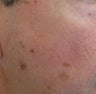 58 year old Male with undesired Pigmentation on face